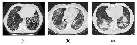 Jcm Free Full Text Interstitial Lung Disease In Rheumatoid