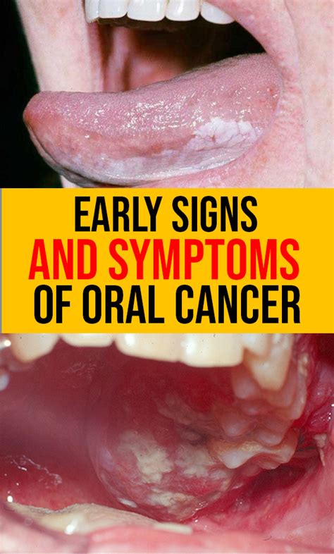 Black Spot Mouth Cancer