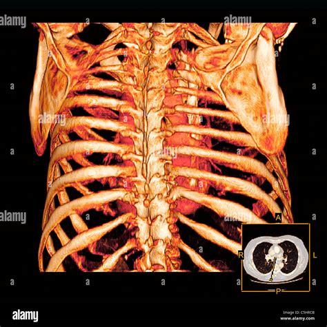 Rib Cage And Heart 3d Ct Scan Stock Photo Alamy