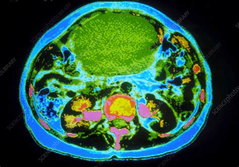Coloured Ct Scan Showing A Large Ovarian Cancer Stock Image M850