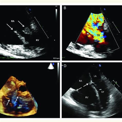 Anatomy Of The Normal Tricuspid Valve Showing Orientation Of The