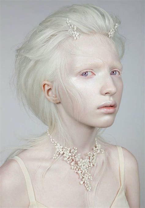 9 Rare Conditions That Are Real Albino Model Albino Girl Albinism