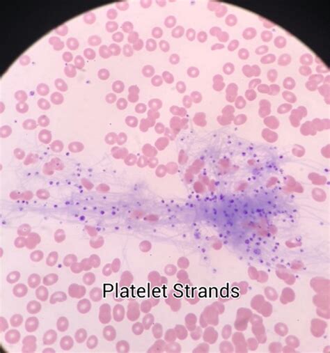 Fibrin Strands With Platelets In A Smear Medical Laboratories