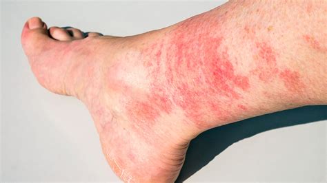 Red Rash On Upper Legs