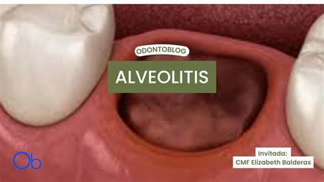 Alveolitis Qué Es Síntomas Y Tratamiento Youtube