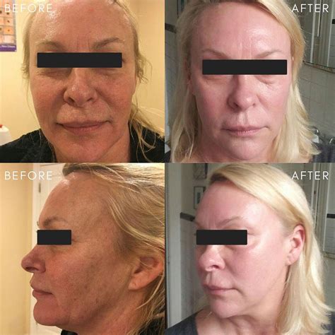 Laser Skin Resurfacing Types Effects Risks Cost