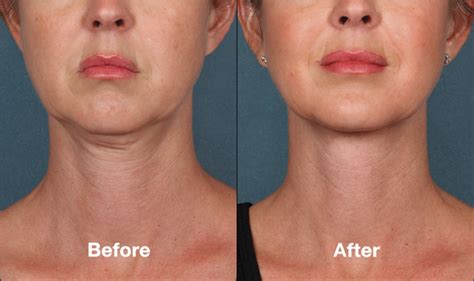 Kybella Treatment For Your Double Chin Beverly Hills Ca