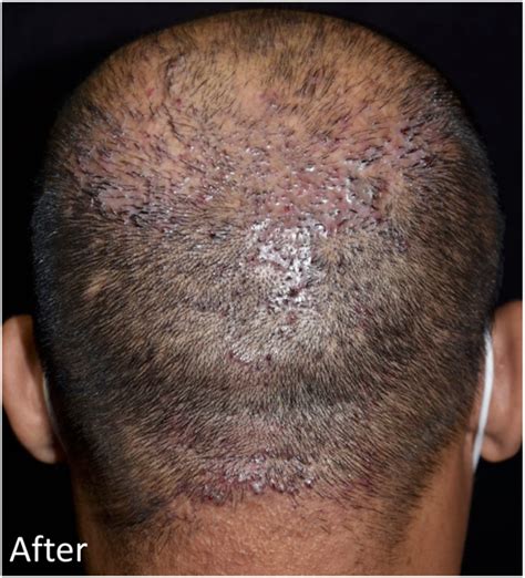 Serial Punch Excisions Followed By Second Intention Healing For Acne