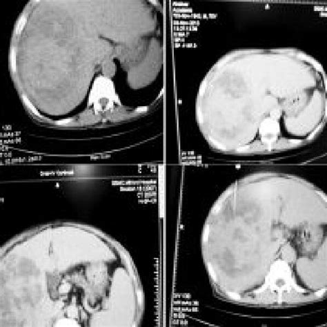 Triple Phase Axial Ct Scan Showing A Well Marginated Hcc In Right Lobe
