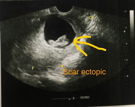 Journal Of Postgraduate Gynecology And Obstetrics Scar Ectopic Pregnancy