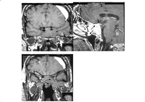 Magnetic Resonance Imaging Of The Sella Turcica Before Starting