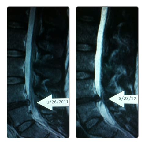 Joint pain, ankylosing spondylitis etc. Pin on Bulging disc