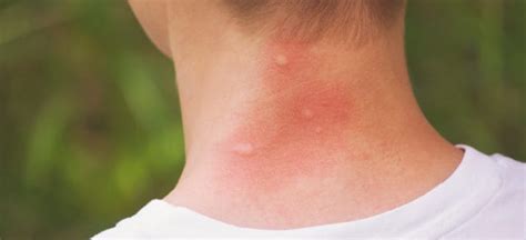 Top 5 Home Remedies For Mosquito Bites Dr Axe