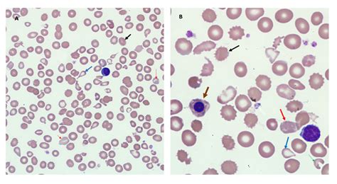 Cureus A Rare Case Of Hemoglobin Ebeta Thalassemia And Systemic