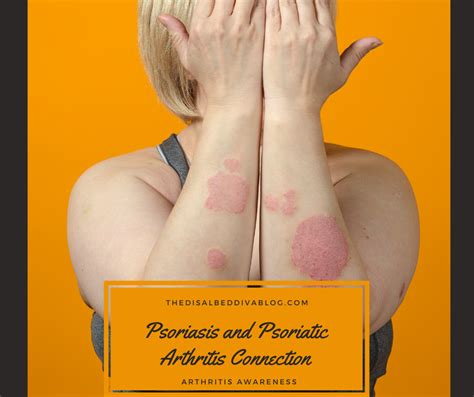 Psoriasis And Psoriatic Arthritis Connection The Disabled Divas Blog