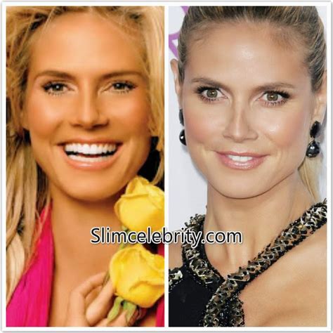 Did Heidi Klum Get Plastic Surgery Nose Job Breast Implants Before And