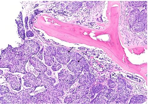 Cureus Skeletal Mets From Squamous Cell Carcinoma Of The Lower Limb