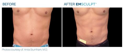 Emsculpt Body Contouring Burn Fat And Build Muscle