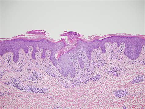 Lymphocytoma Cutis Dermatopathology