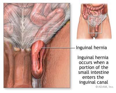 Hernia Symptoms Diagnosis Treatment Of Hernia NY Times Health