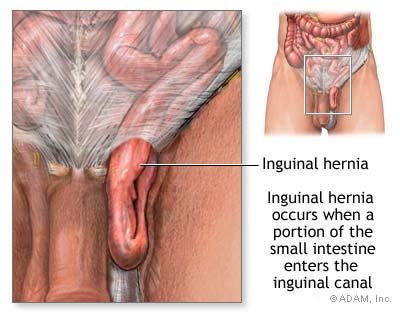 Ppt Inguinal Canal Inguinal Hernia Male External Genitalia My Xxx Hot