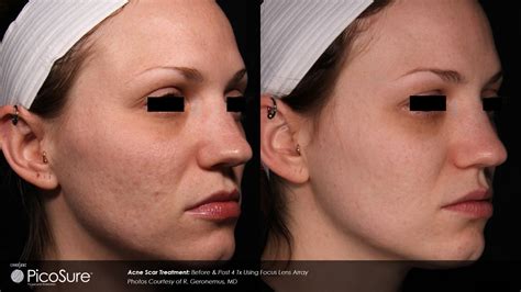 Acne Scar Treatment Sydney Large Pores Treatment