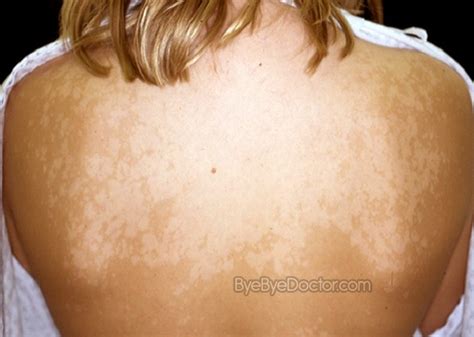 Tinea Versicolor Pictures Symptoms Causes Natural Treatment