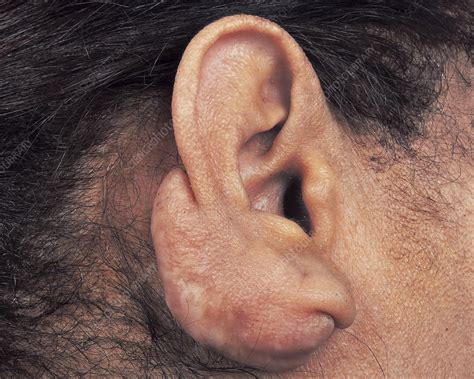Keloid Scarring After Ear Piercing Stock Image C0461711 Science Photo Library