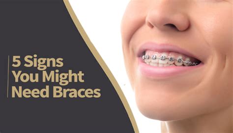 Do You Need Braces 5 Signs You Can Look For