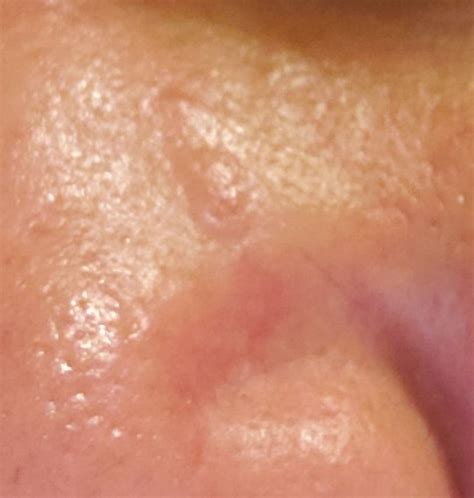 Tried Removing Sebaceous Hyperplasia On Nose And Now I Have Slightly Raised Pink Skin