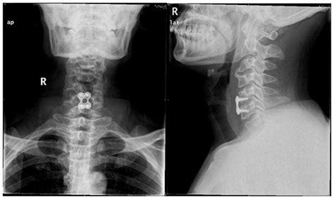 Cervical spondylosis is degeneration of the bones in the neck (vertebrae) and the disks between them, putting pressure on (compressing) the spinal cord in. Cervical spondylotic myelopathy with vitamin B12 ...