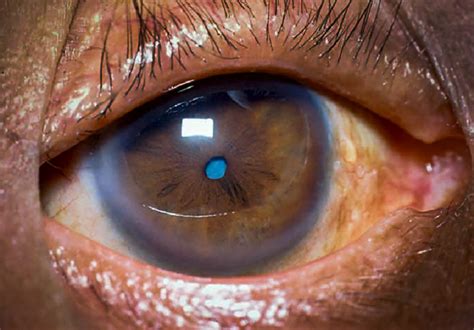 Community Eye Health Journal Management Of Cataract Surgery In