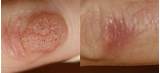 Wart Removal Doctor Cost Images