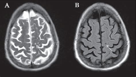 Figure 1 From Cerebral Small Vessel Disease And Motoric Cognitive Risk