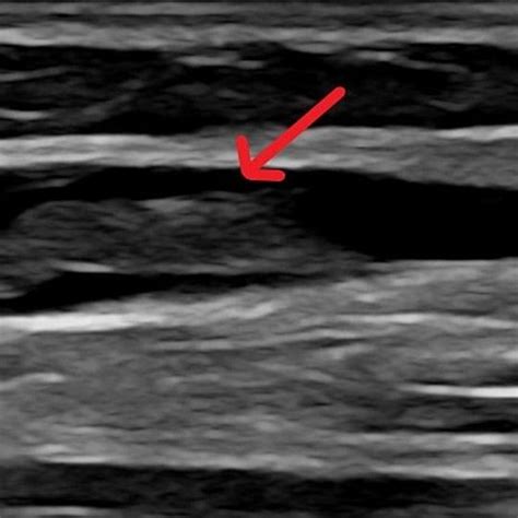 Ultrasound Of Right Upper Arm Showing Thrombus In Basilic Vein
