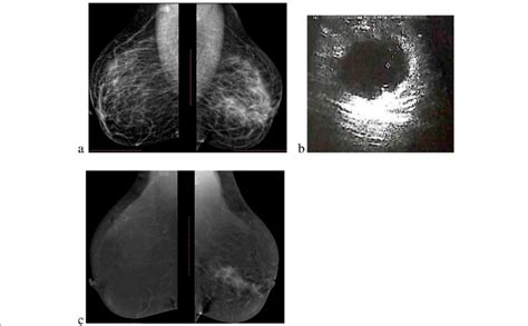A Case Of Periductal Mastitis With Left Focal Asymmetry Seen In Digital