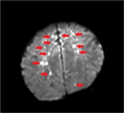Diffusion Weighted Mri Brain Showing Scattered Foci Of Diffusion