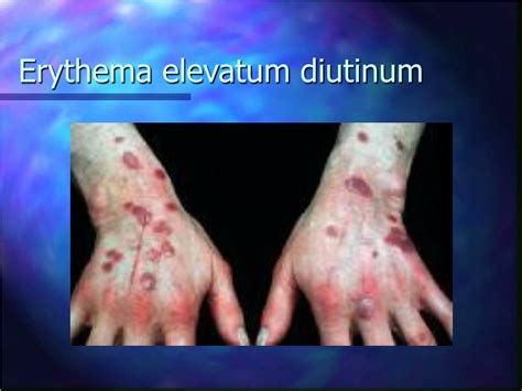 Ppt Cutaneous Vascular Diseases Powerpoint Presentation Free