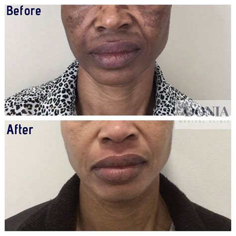 Top 91 Images Hyperpigmentation Before And After Photos Superb