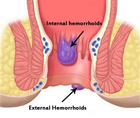 Haemorrhoids Overview Dr Anastasios Christodoulou