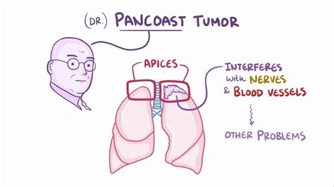 Pancoast Tumor Video Anatomy Definition And Function Osmosis
