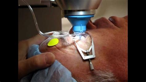 What Is Laser Cataract Surgery Vilreole