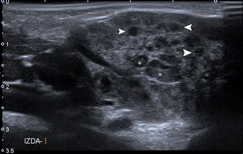 Imaging Evaluation Of Pediatric Parotid Gland Abnormalities Radiographics