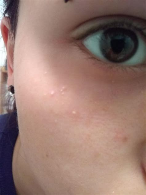 [skin concerns] White heads? Is there anything i can do to ...