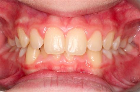 Gum Recession In Orthodontics Black Triangles