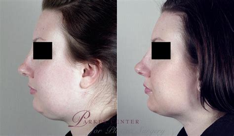 Neck Contouring Before And After Pictures Case 220 Paramus Nj