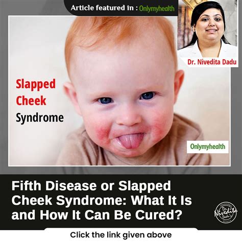 Fifth Disease Or Slapped Cheek Syndrome Is One Of Them It Is A Viral
