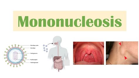 Infectious Mononucleosis Mono Epstein Barr Virus Transmission