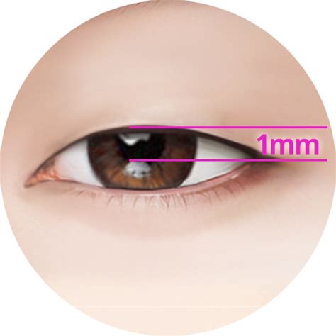 عملية تصحيح العيون في كوريا علاج العين 【id Hospital】