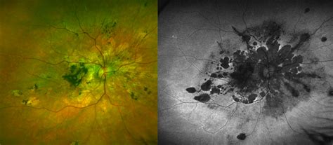Severe Macular Atrophy Secondary To Pseudoxanthoma Elasticum And Cnv
